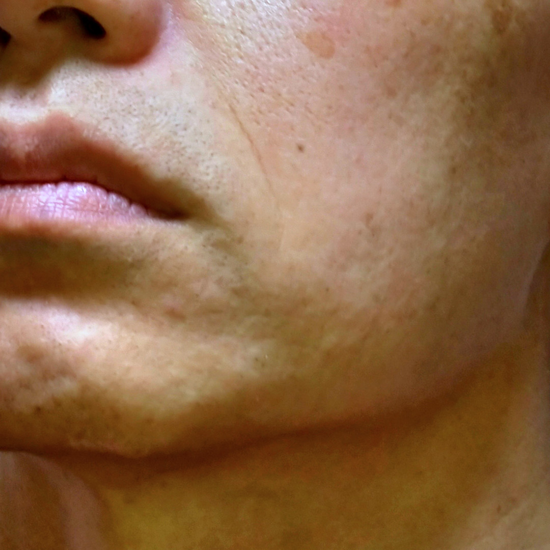 メンズ脱毛サロンでヒゲ脱毛を5回終了した体験談【比較写真 ...